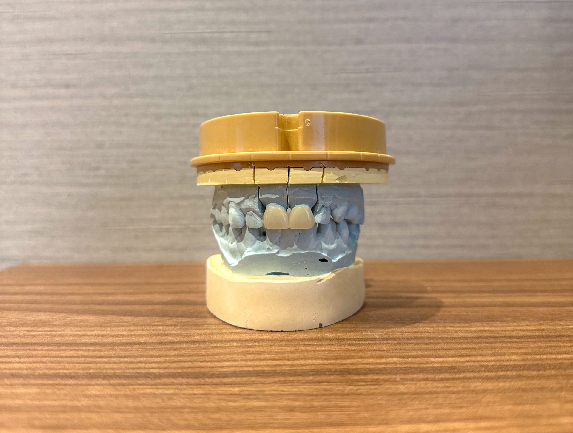 Dental Crowns