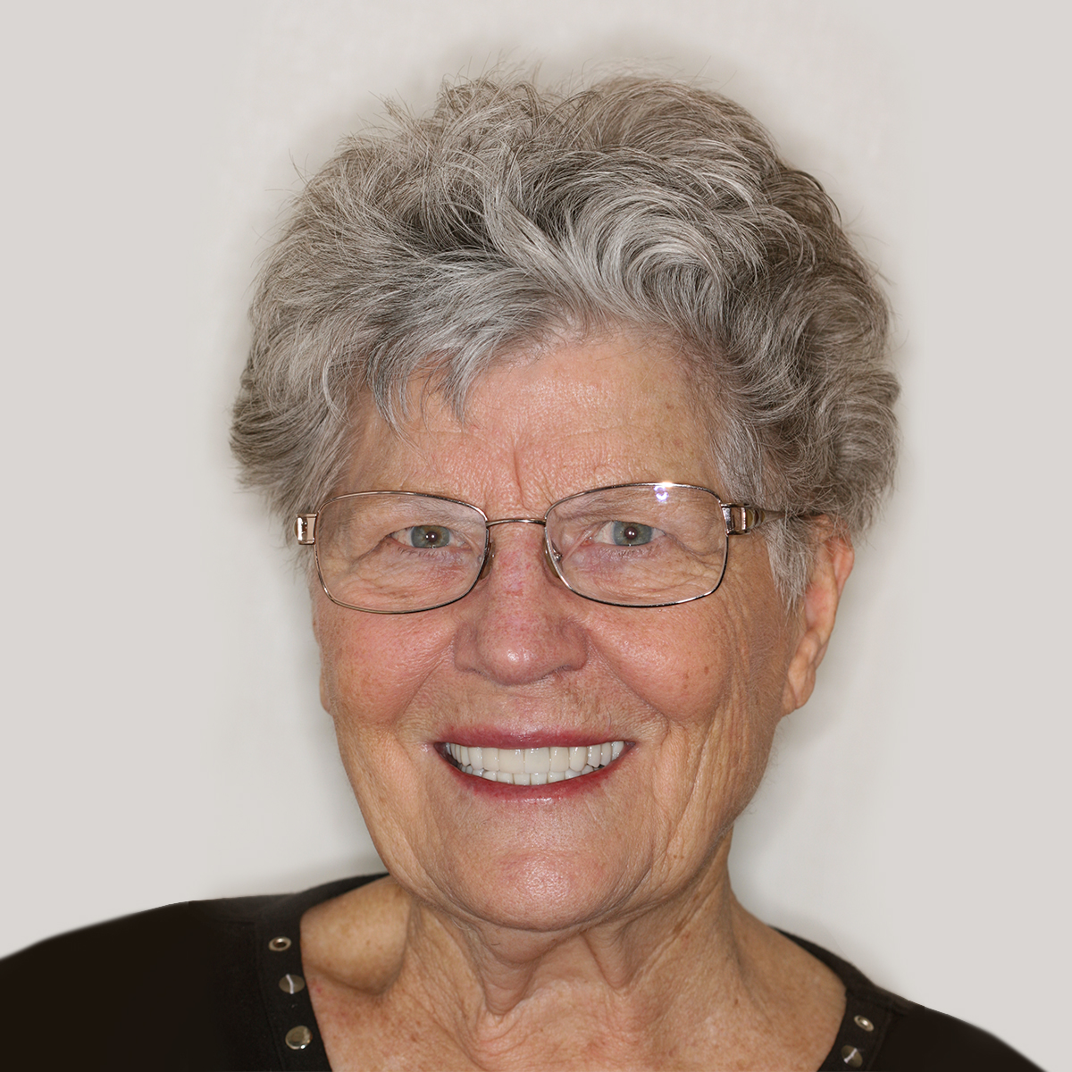 Helen Smile Gallery Results After