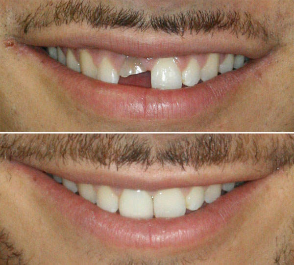 Michael Before After