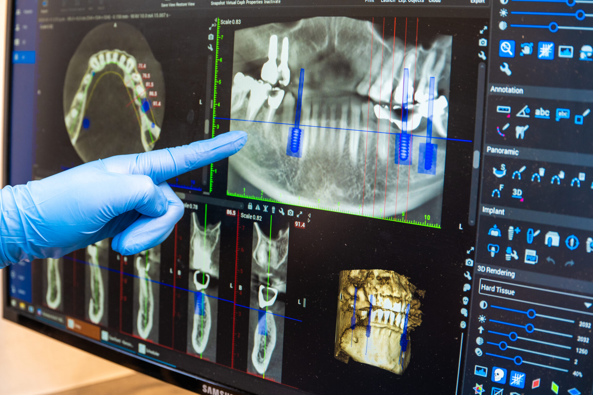 How much do dental implants cost in 2025? X-Ray of teeth. 